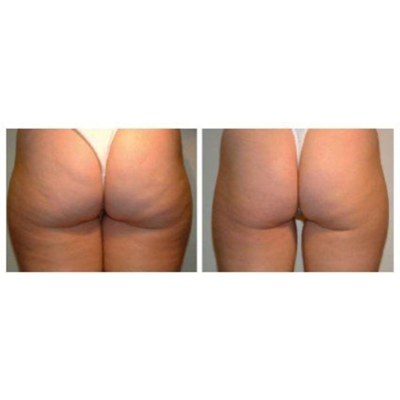 combatir-la-celulitis