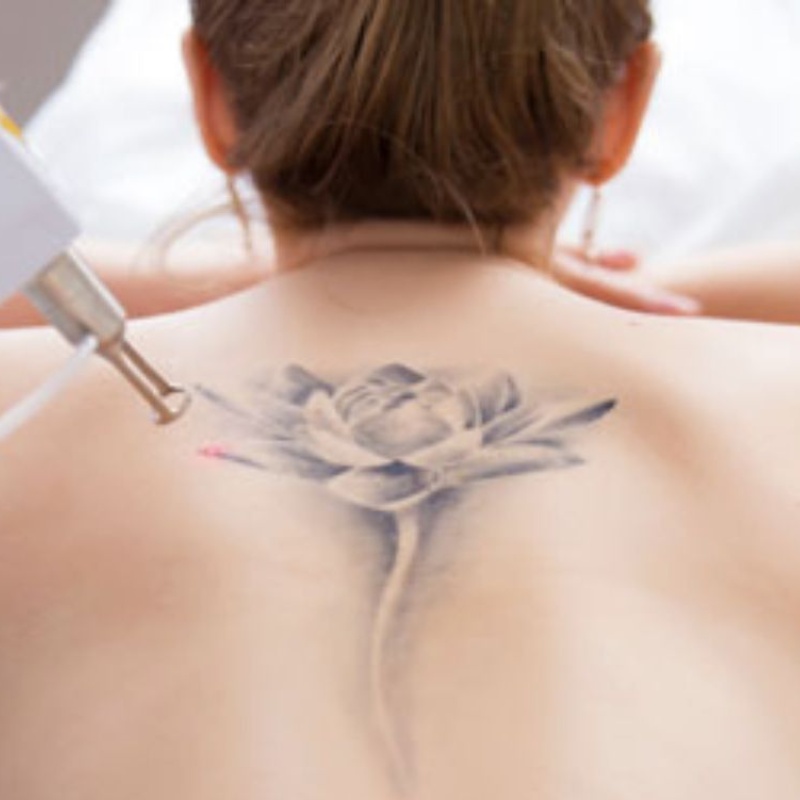 eliminacion-de-tatuajes