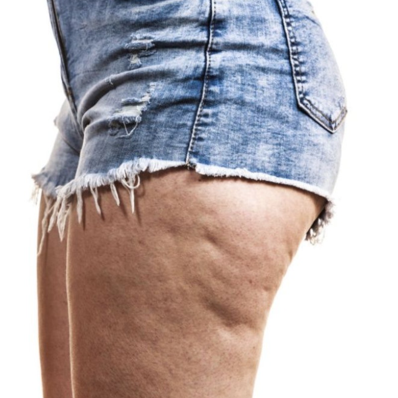 hablamos-de-celulitis