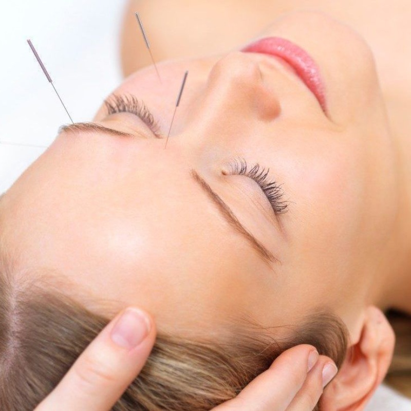 acupuntura-y-lifting-facial