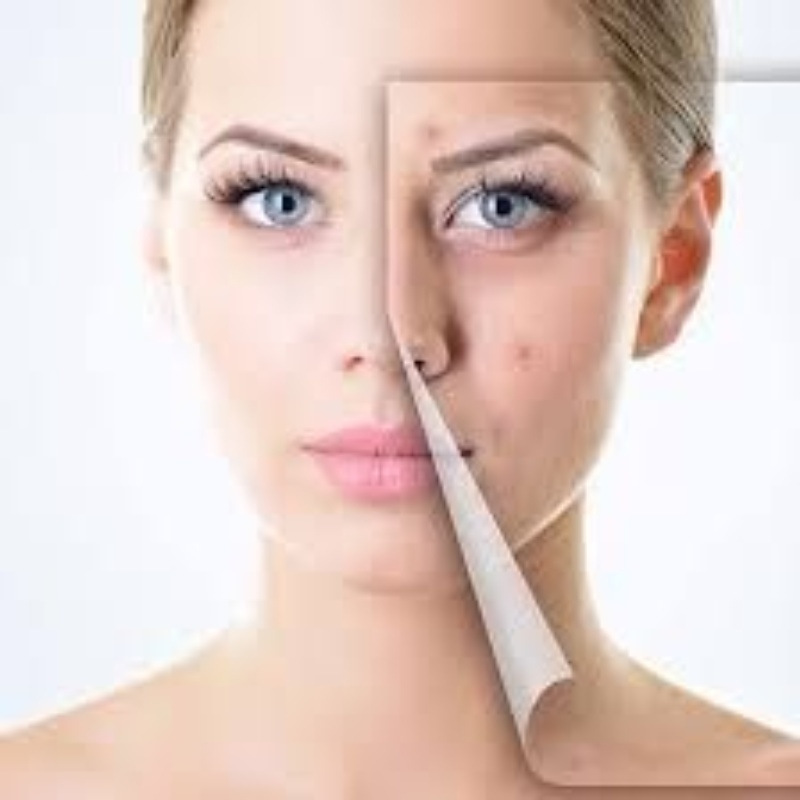 peeling-quimico