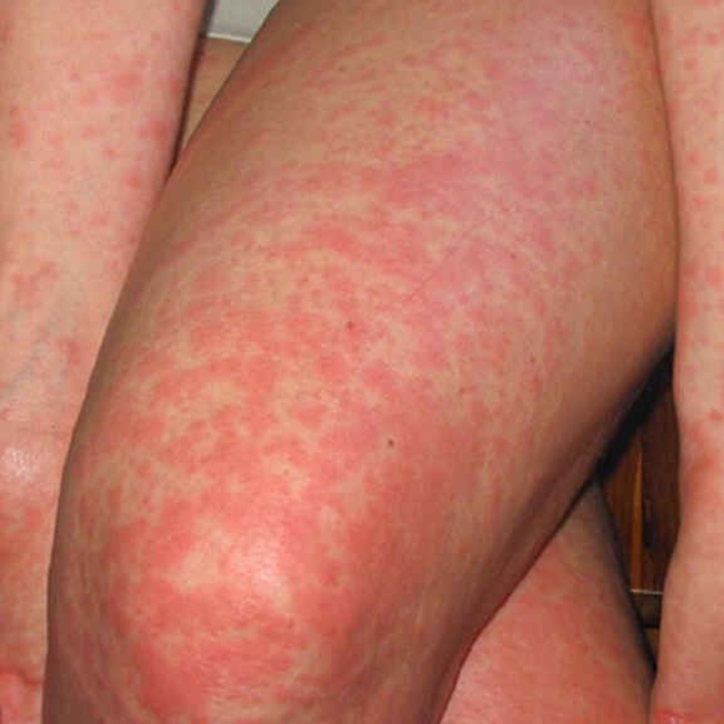alergia-al-sol