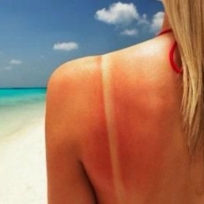consejos-para-aliviar-quemaduras-solares