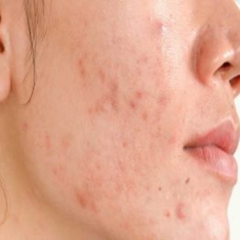 acne-en-la-menopausia