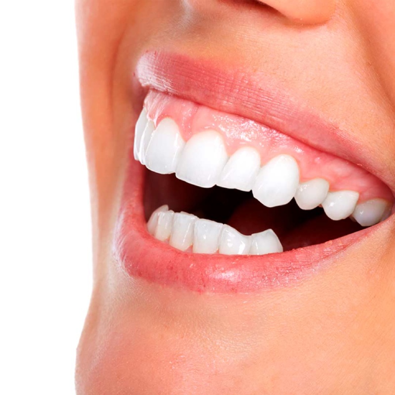 sonrisa-gingival