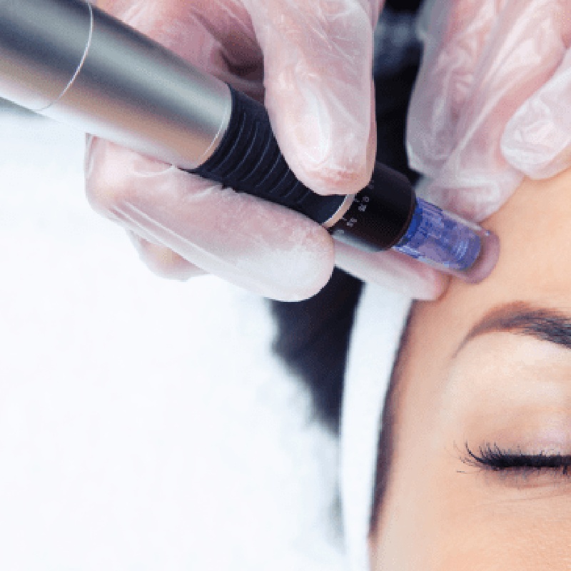 microneedling-la-tecnica-que-seguira-revolucionando-la-revitalizacion-de-la-piel