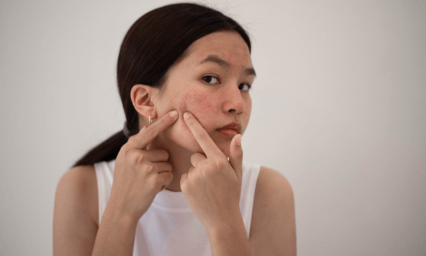 como-combatir-el-acne-de-forma-efectiva