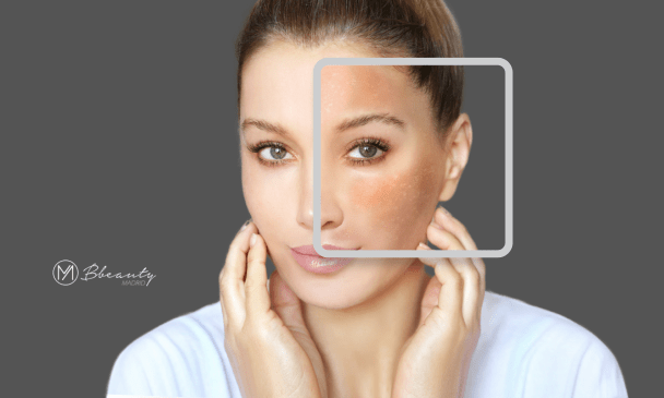 tratamientos-naturales-para-manchas-en-la-piel