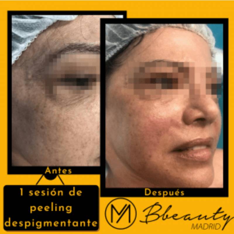 resultado-tratamiento-1-sesion-de-peeling-despigmentante