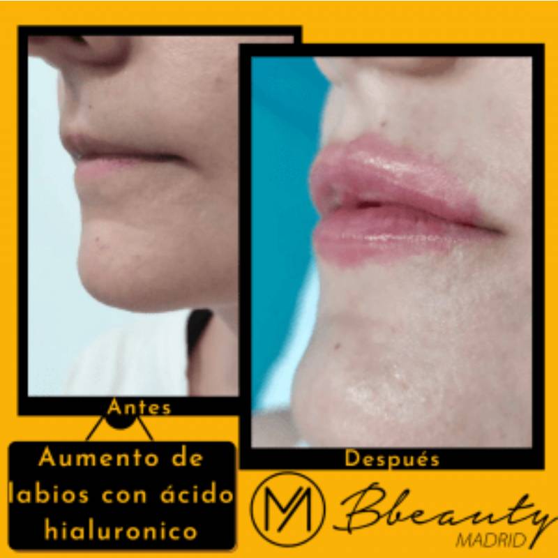 resultado-tratamiento-aumento-de-labios-con-acido-hialuronico