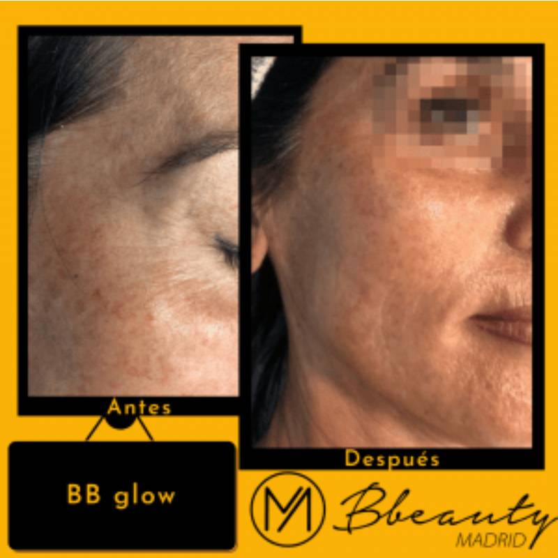 resultado-tratamiento-bb-glow