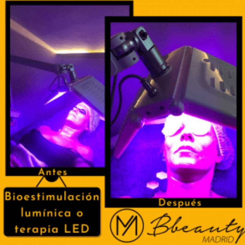 resultado-tratamiento-bioestimulacion-luminica-o-terapia-led