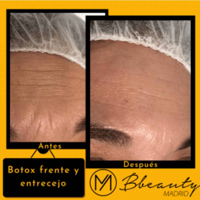 resultado-tratamiento-botox-frente-y-entrecejo