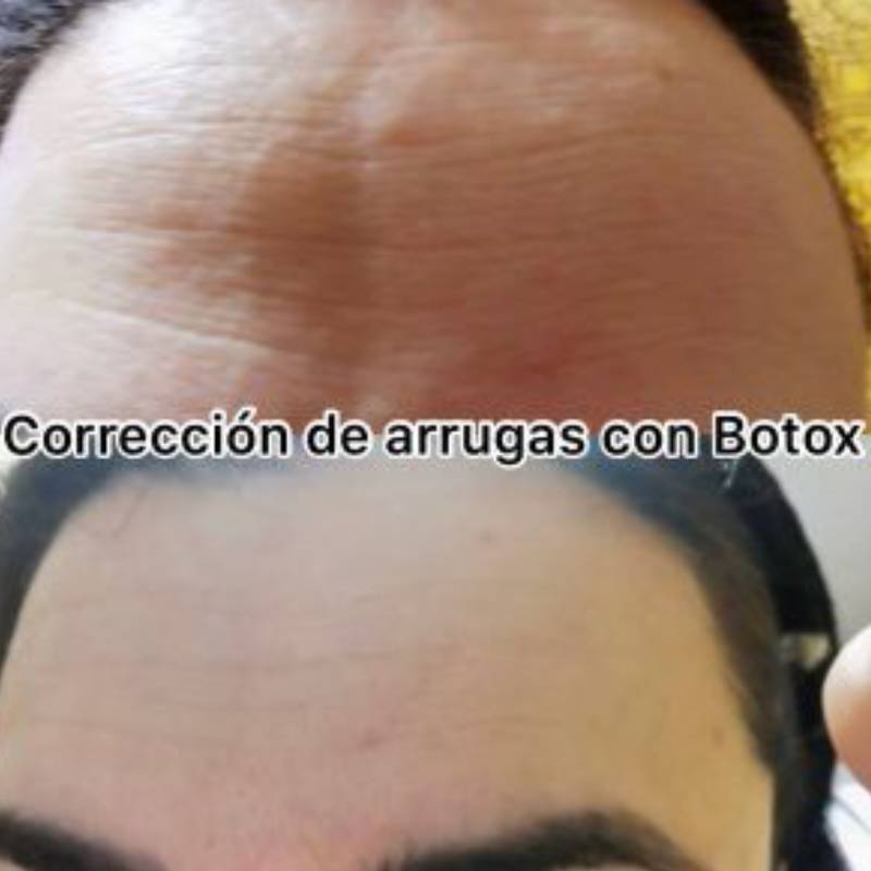 resultado-tratamiento-correccion-de-arrugas-con-botox