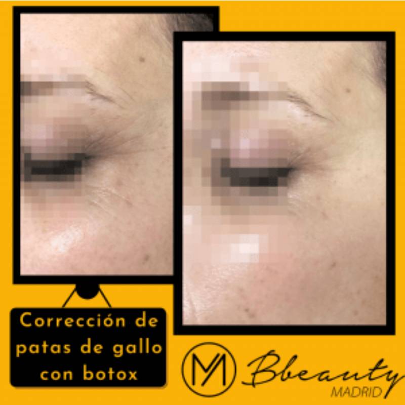 resultado-tratamiento-correccion-de-patas-de-gallo-con-botox (1)