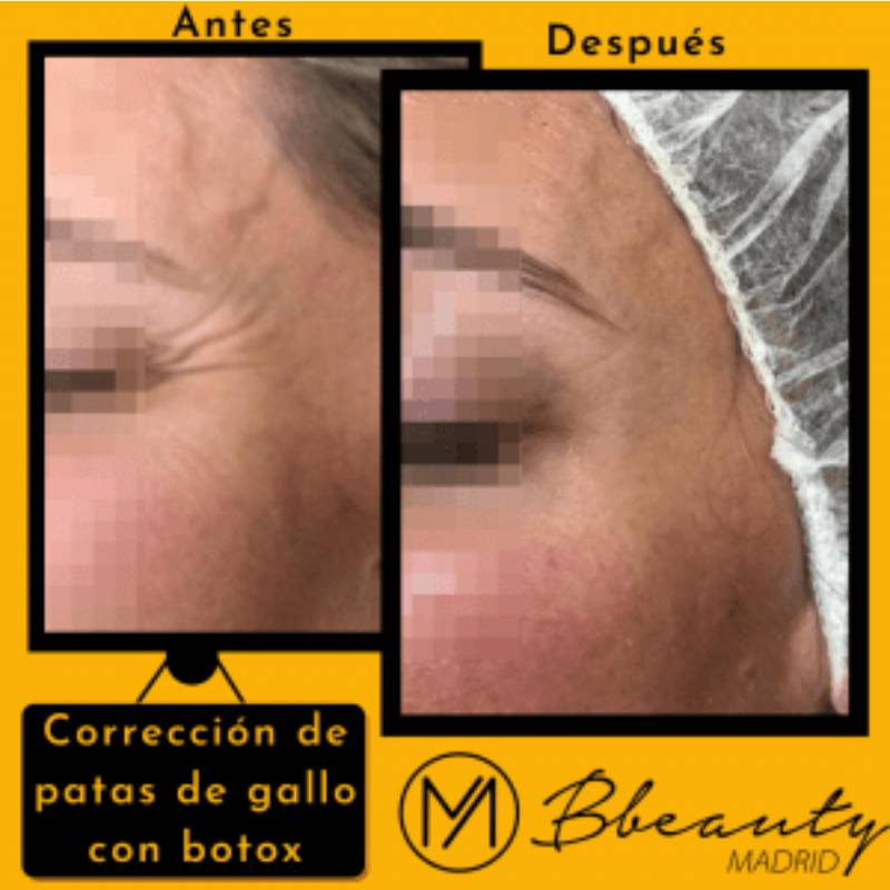 resultado-tratamiento-correccion-de-patas-de-gallo-con-botox (2)