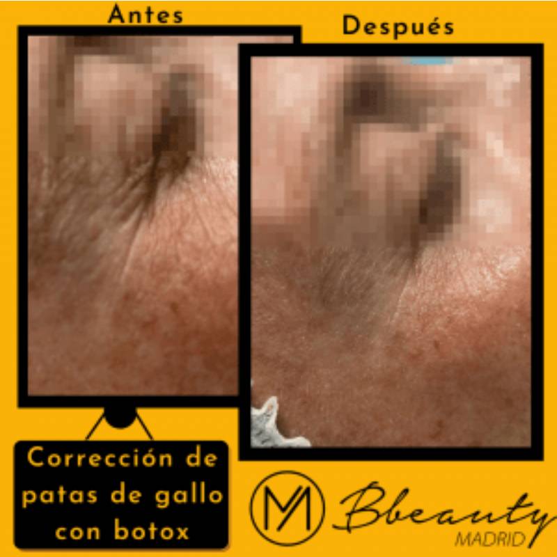 resultado-tratamiento-correccion-de-patas-de-gallo-con-botox (3)