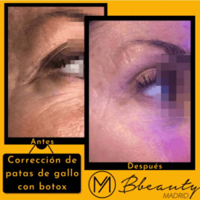 resultado-tratamiento-correccion-de-patas-de-gallo-con-botox