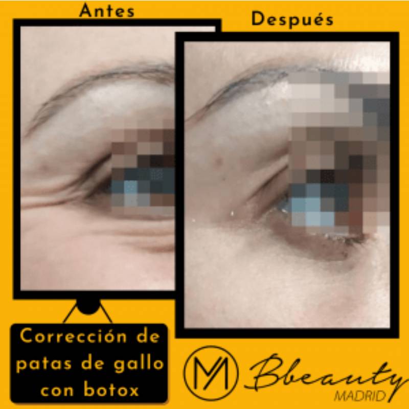 resultado-tratamiento-correccion-de-patas-de-gallo