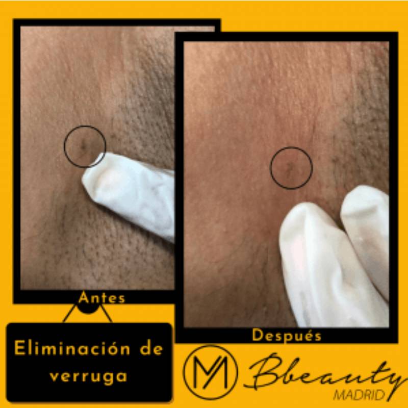 resultado-tratamiento-eliminacion-de-verruga