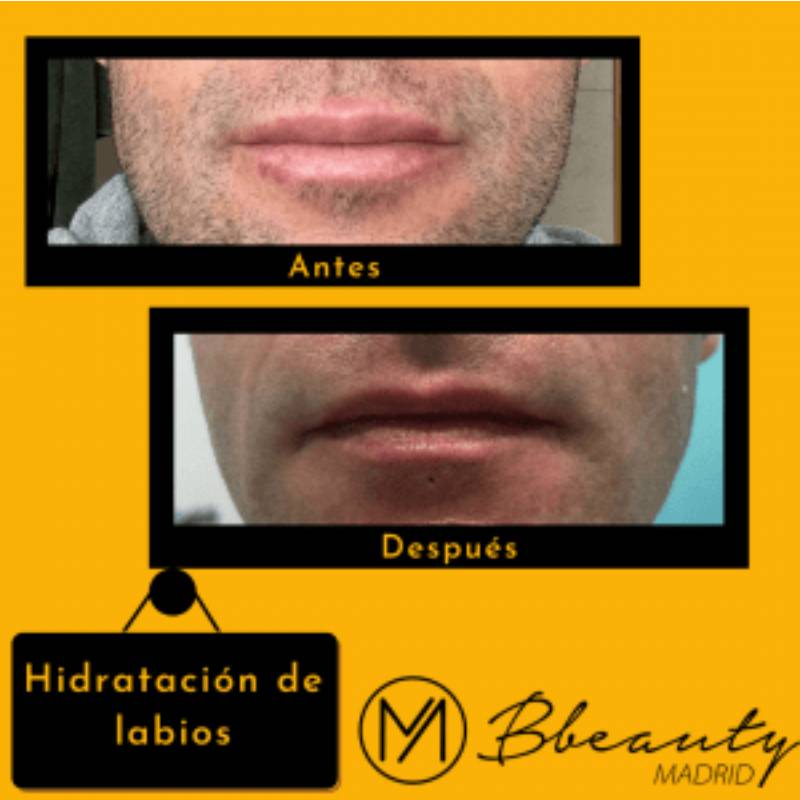 resultado-tratamiento-hidratacion-de-labios (1)