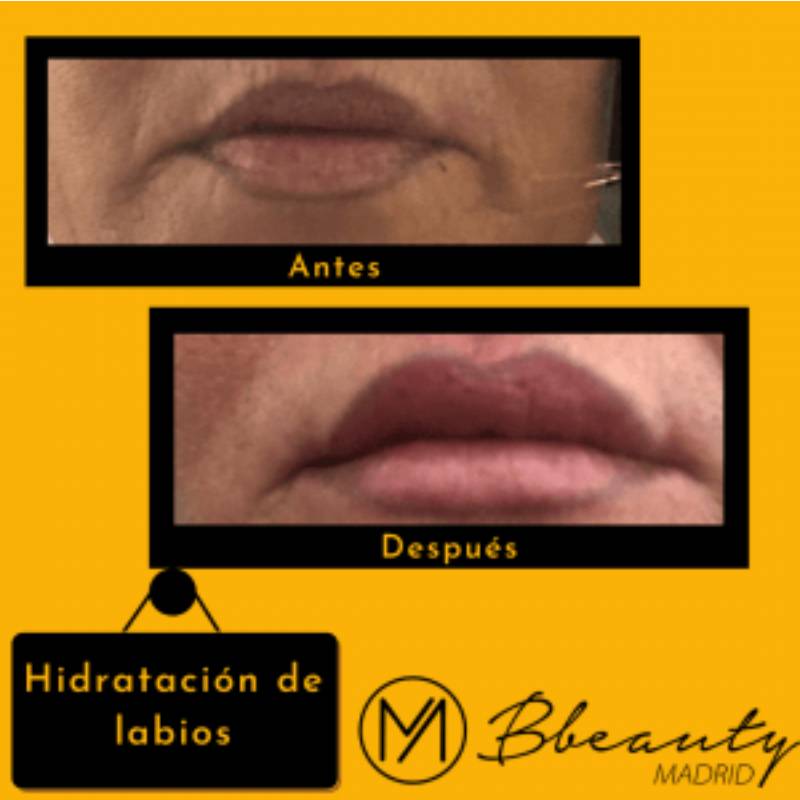 resultado-tratamiento-hidratacion-de-labios (2)