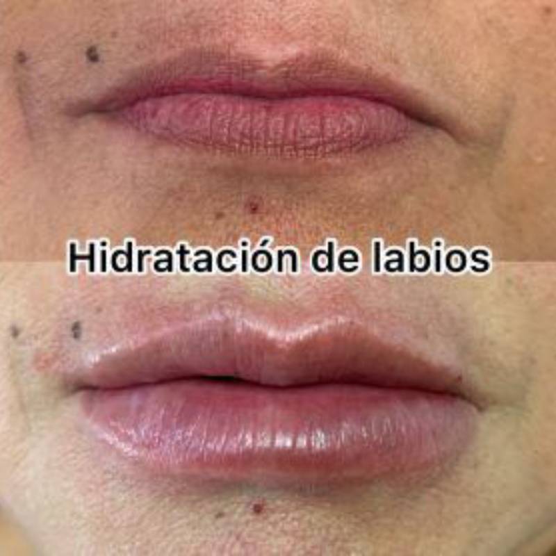 resultado-tratamiento-hidratacion-de-labios (3)