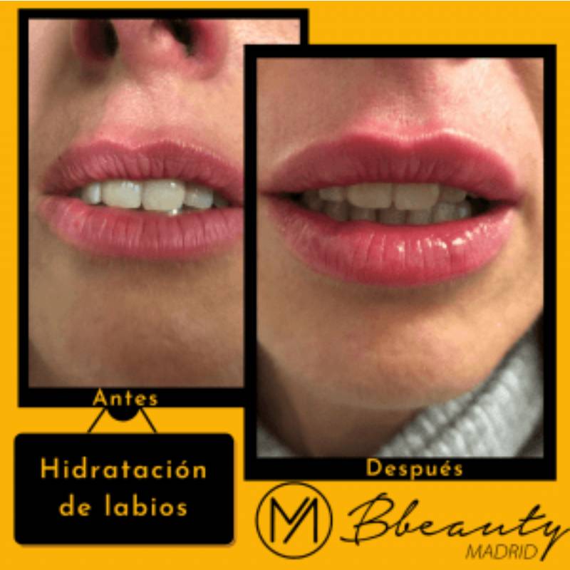 resultado-tratamiento-hidratacion-de-labios
