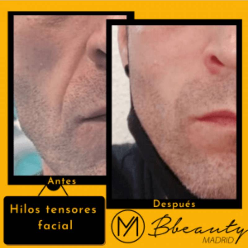 resultado-tratamiento-hilos-tensores-facial