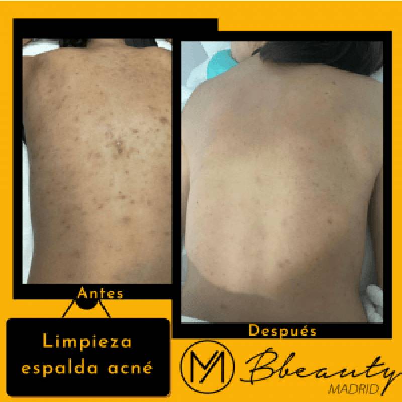 resultado-tratamiento-limpieza-espalda-acne