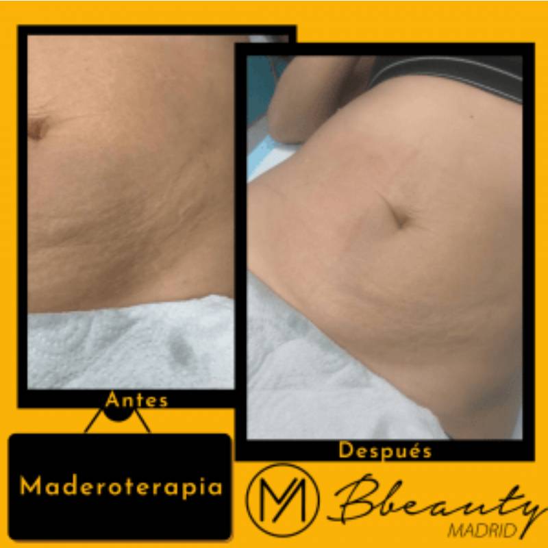 resultado-tratamiento-maderoterapia