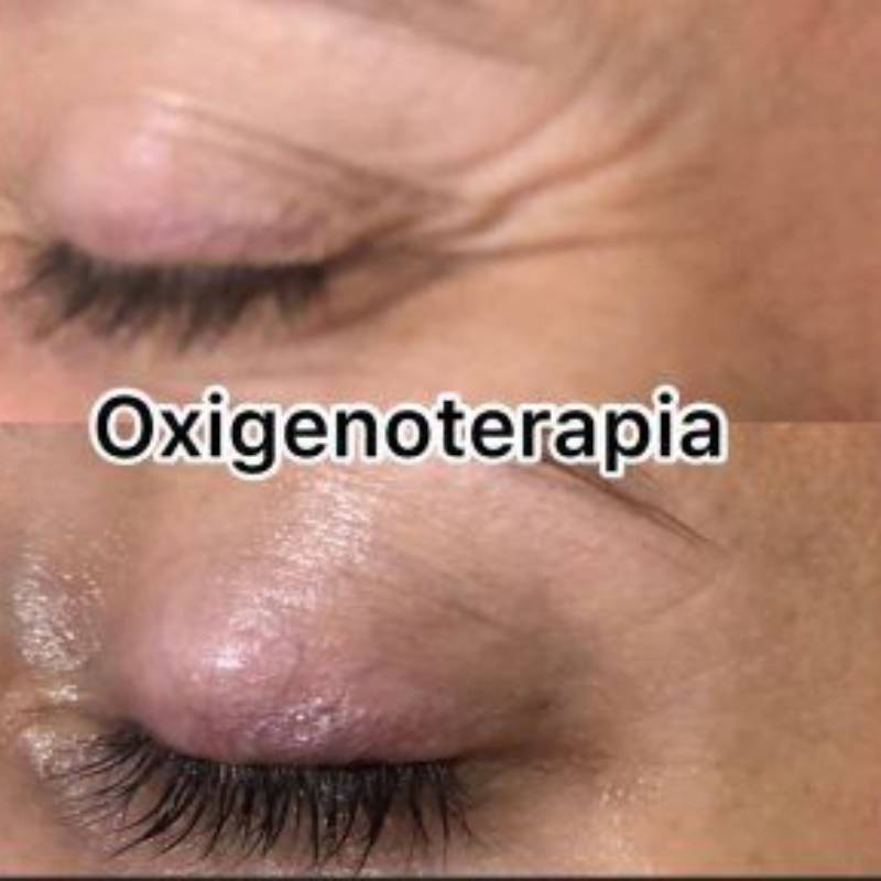 resultado-tratamiento-oxigenoterapia