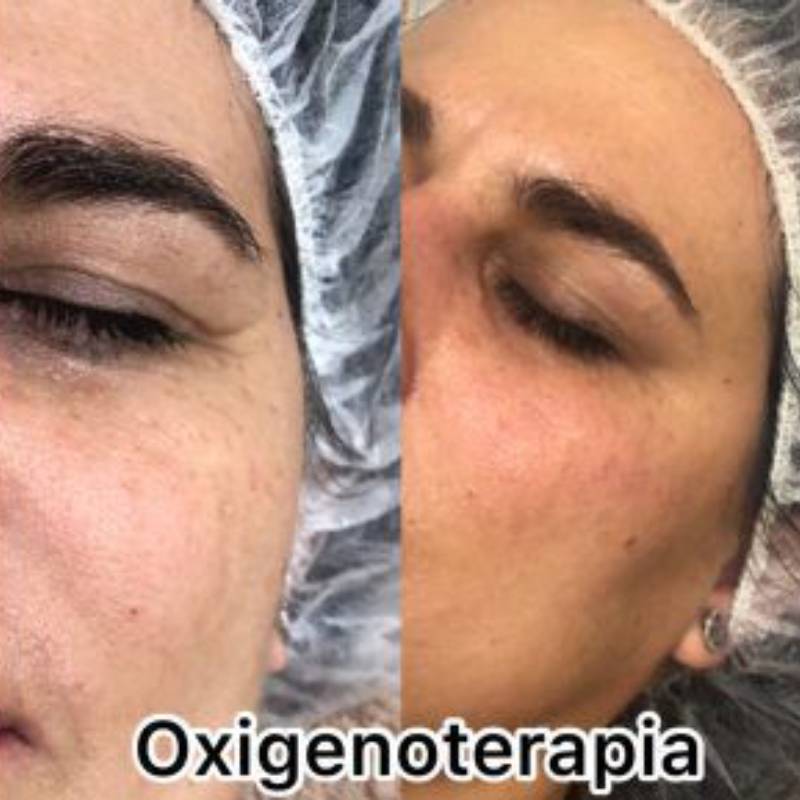 resultado-tratamiento-oxigenoterpia