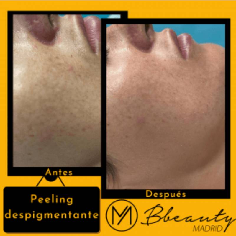 resultado-tratamiento-peeling-despigmentante