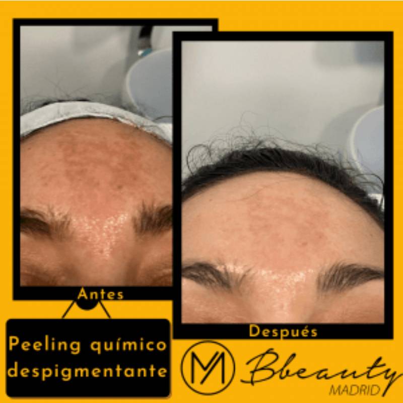 resultado-tratamiento-peeling-quimico-despigmentante (1)