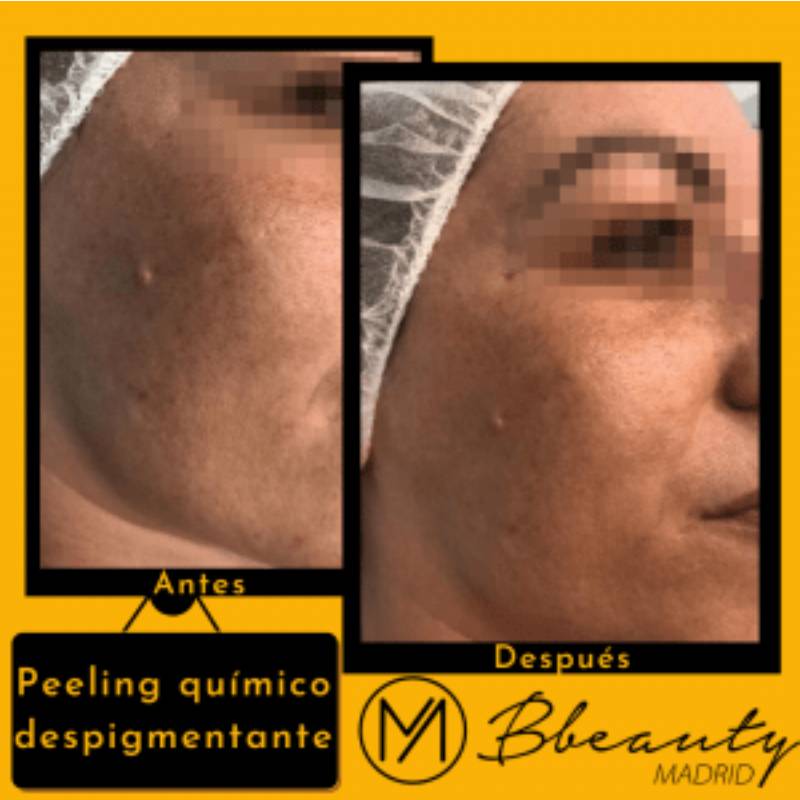 resultado-tratamiento-peeling-quimico-despigmentante