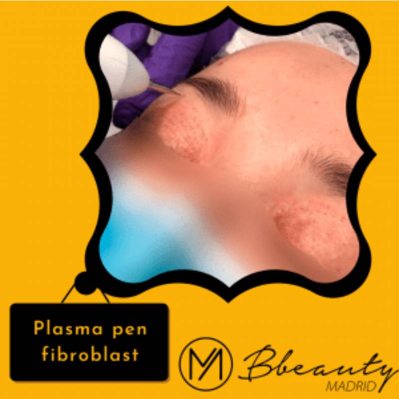 resultado-tratamiento-plasma-pen-fibroblast