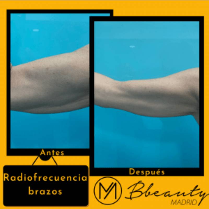resultado-tratamiento-radiofrecuencia-brazos