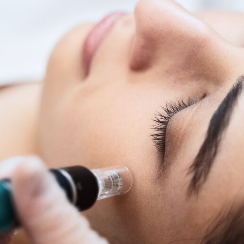 tratamiento-dermapen-facial-con-activos