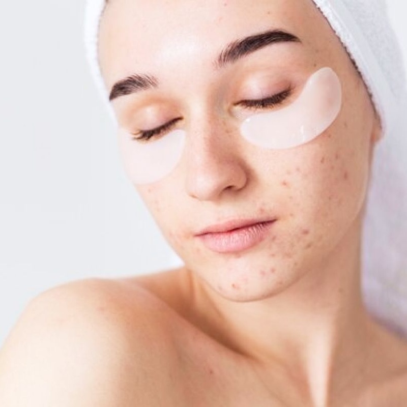 tratamiento-facial-para-pieles-grasas-y-acne
